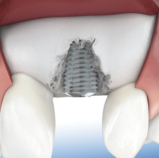 jaw-bone-augmentation