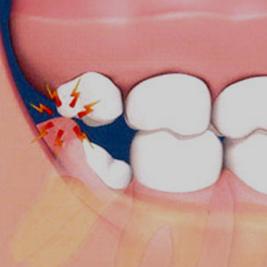 wisdom-teeth