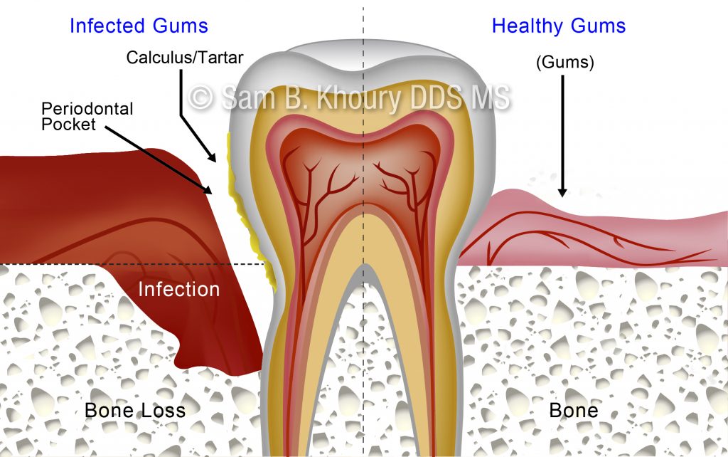 Bone grafting 1