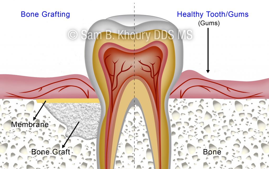 Bone grafting 2