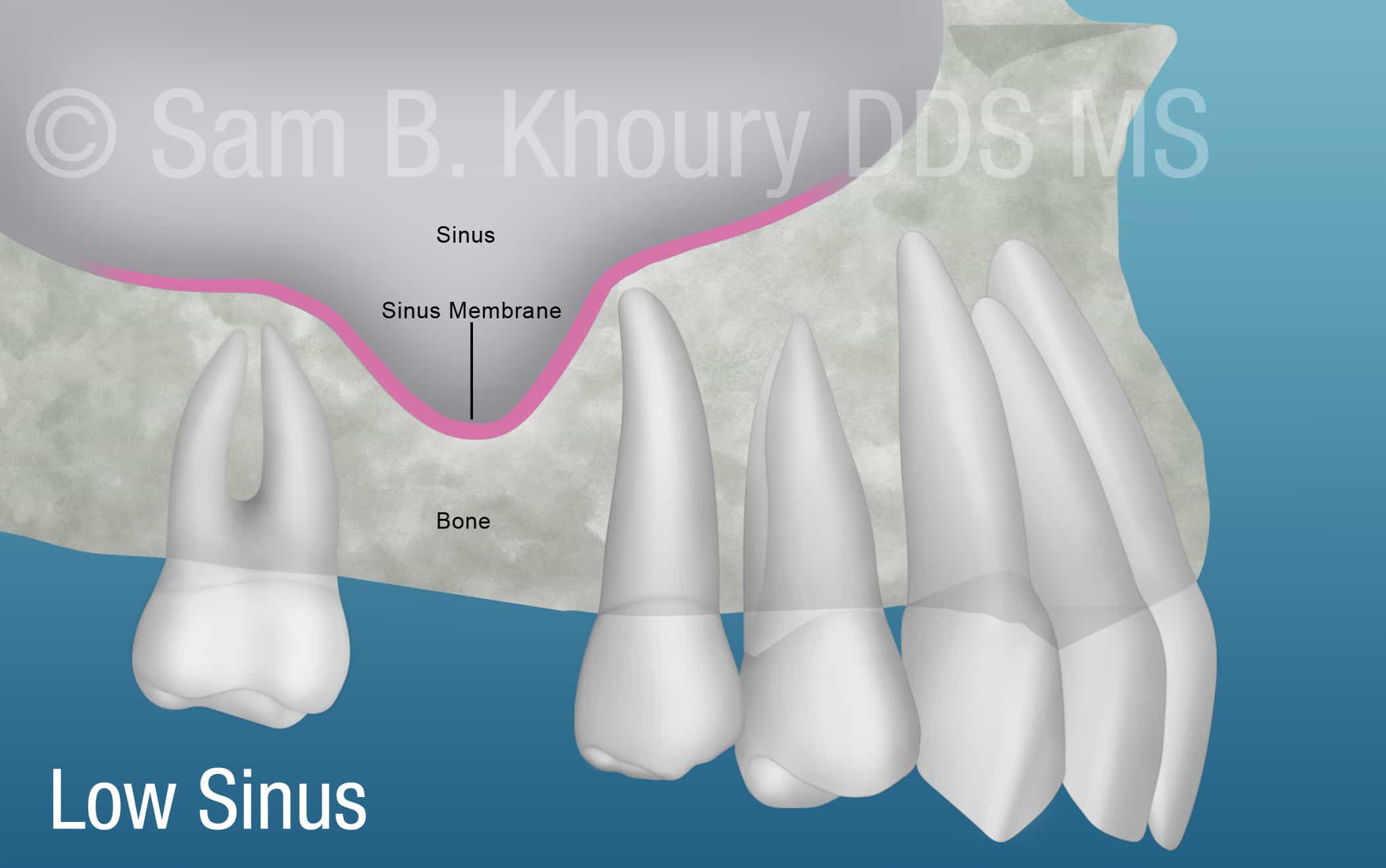 Low Sinus