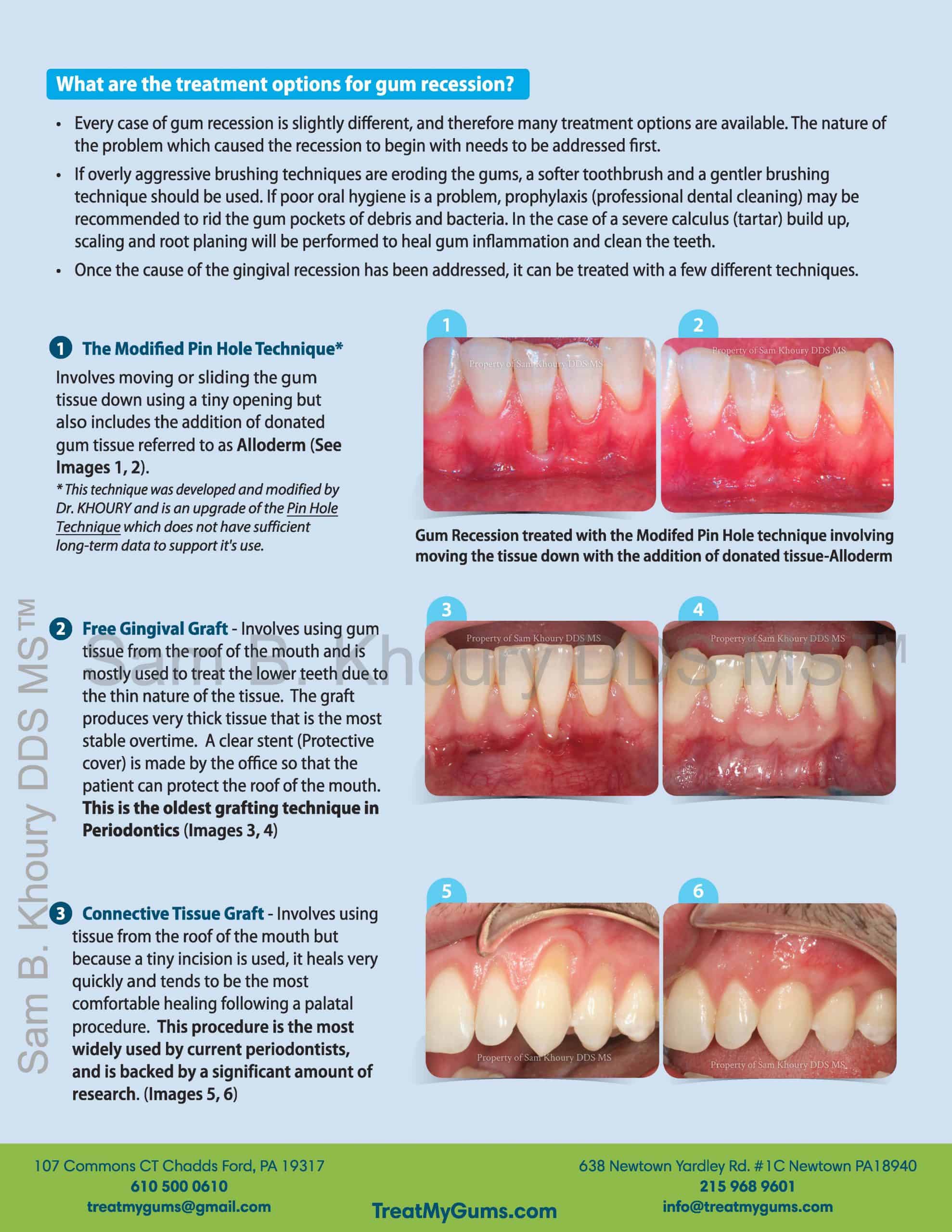 Gum-Grafting-Only-scaled