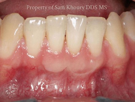 gum-grafting-after