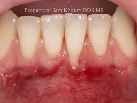 gum-grafting-before