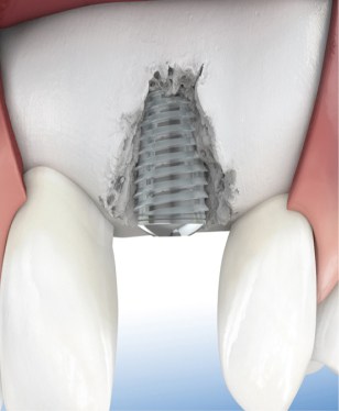 jaw-bone-augmentation-3