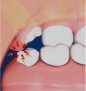 wisdom-teeth-3